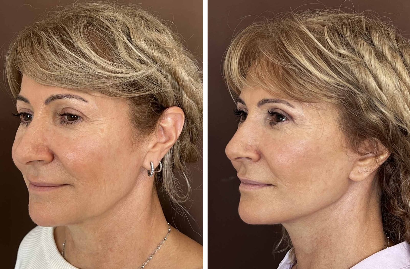 Lifting de cuello caso 4 — antes y después